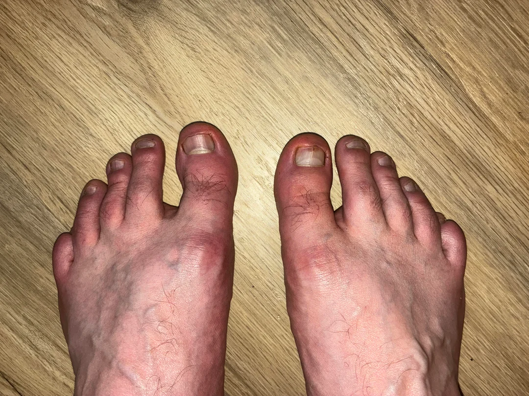 Nail fungus before